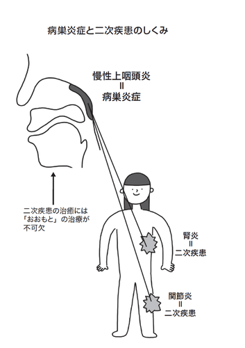 なぜ、鼻の奥の炎症がさまざまな不調を引き起こすのか