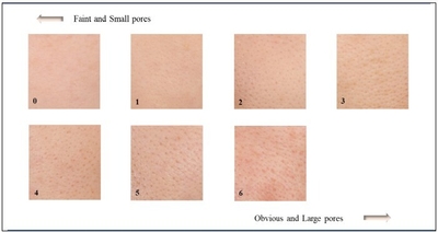 図1 毛穴グレードの評価基準※ ※Kim, S. J., et al. "Pore volume is most highly correlated with the visual assessment of skin pores. " Skin Research and Technology 20.4 (2014): 429-434.