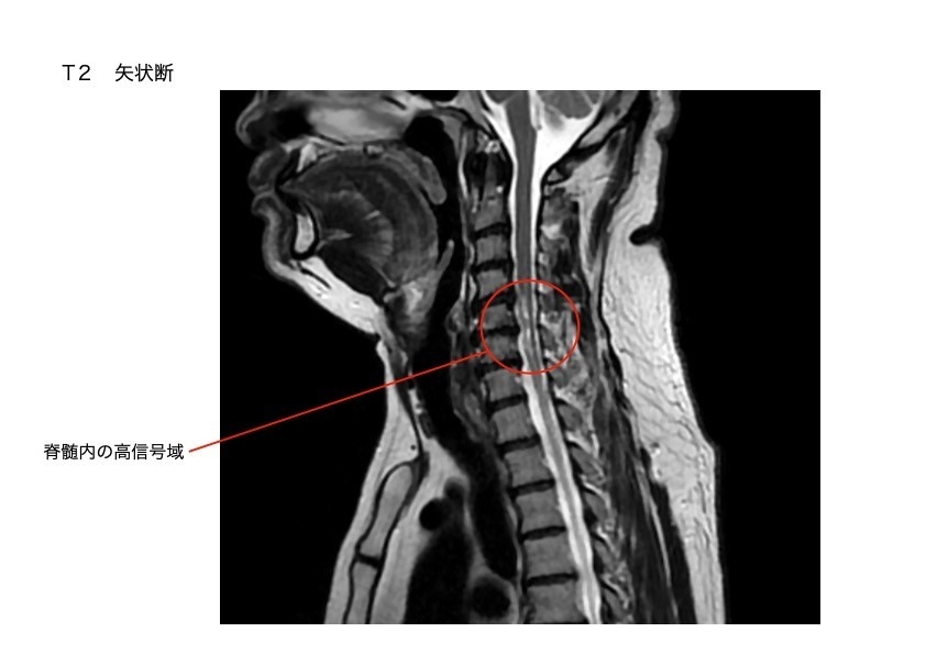 脊髄のMRI画像。矢状断面で脊髄の異常信号を示している