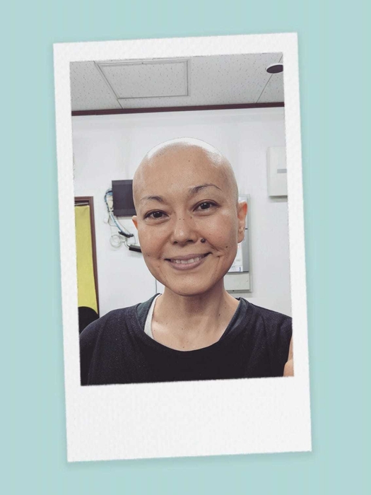 抗がん剤により脱毛した開発者