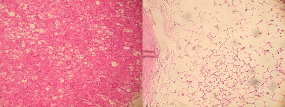 左:胸部大動脈の周囲脂肪組織、右:腹部大動脈の周囲脂肪組織