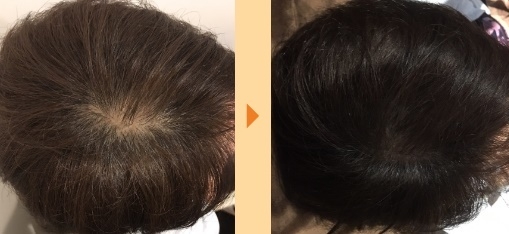 発毛事例:40代女性/25回施術