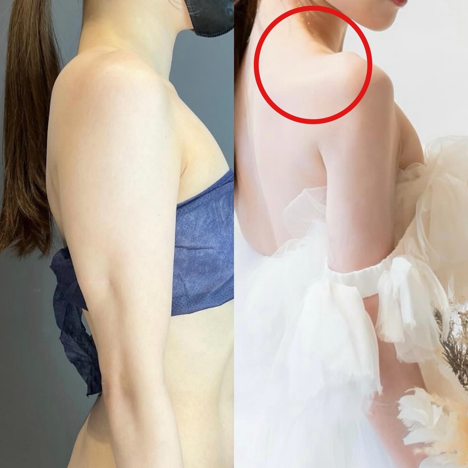 肩周りをスッキリさせたい全ての方へ