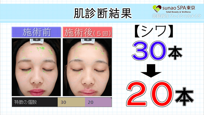 肌診断毛結果(シワ)