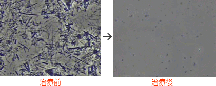 口腔内細菌検査 治療前後1