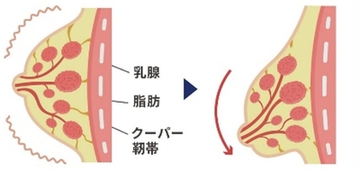 クーパー靭帯に大きく負担