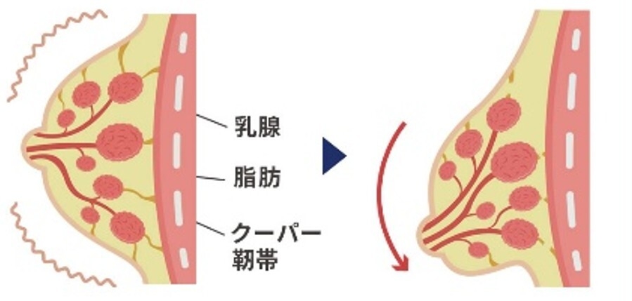 クーパー靭帯に大きく負担