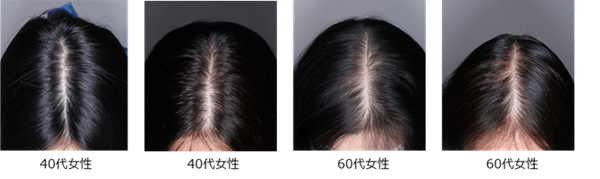 壮年性脱毛症の頭髪写真