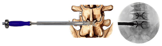 治療イメージ図