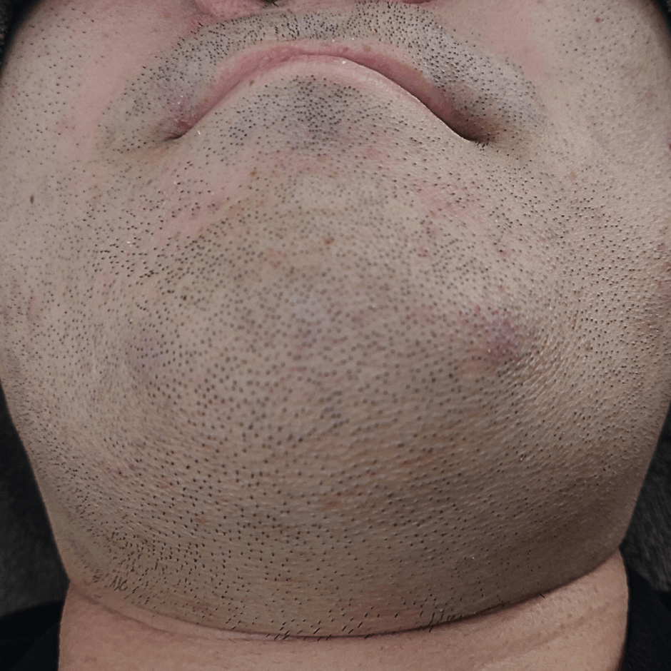 [ヒゲ脱毛施術中の男性写真]