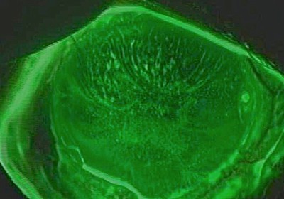 薬剤起因性の角膜障害