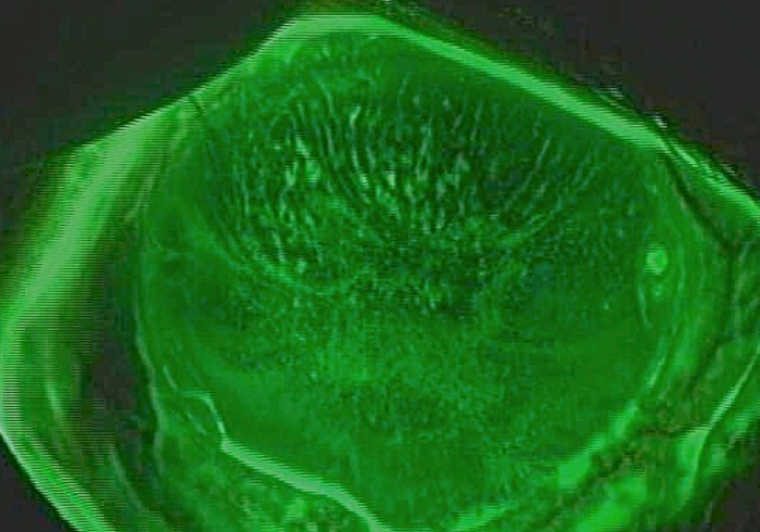 薬剤起因性の角膜障害