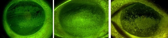 点状表層角膜症(SPK)