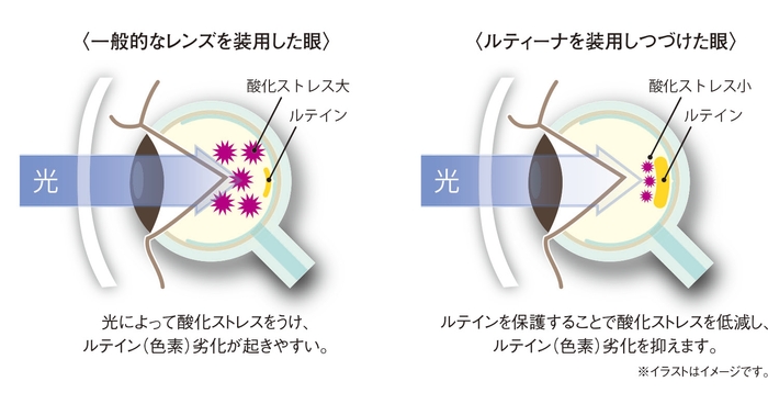 ルティーナ装用イメージ図