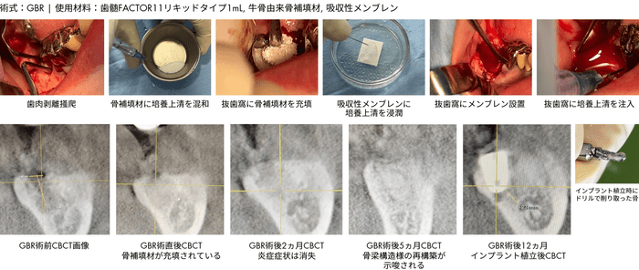 抜歯窩治癒不全GBR症例