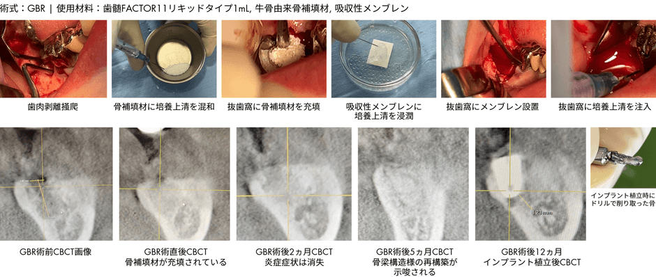 抜歯窩治癒不全GBR症例