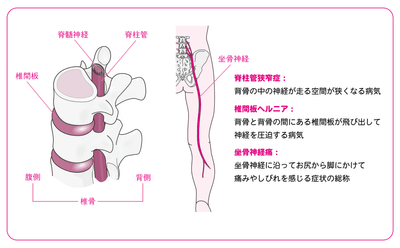痛みやしびれを伴う代表的な疾患