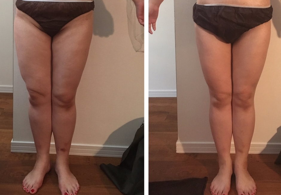 施術による肌質の変化