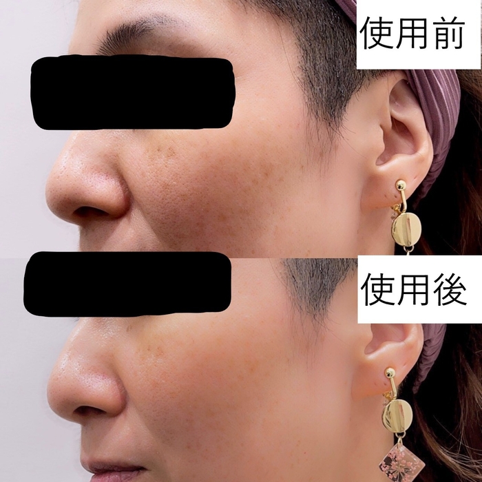 HEPASKIN3Dラ*ラメラ 薬用BBクリームの使用前と使用後