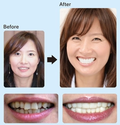 【新生活の印象を1日で変える】「歯を削らない」進化系ラミネートベニア「ルミネアーズ」が、新年度のスマイルアップ需要で相談数急増！