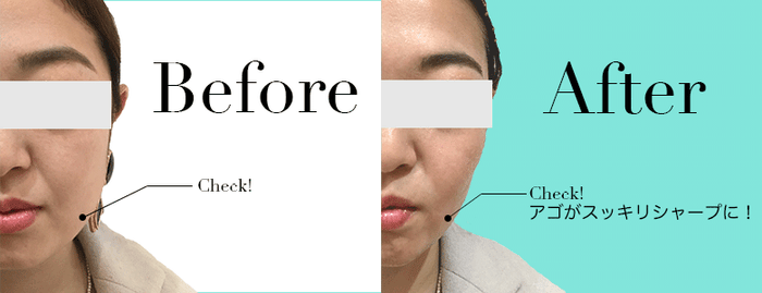 ハイフ・ビフォーアフター