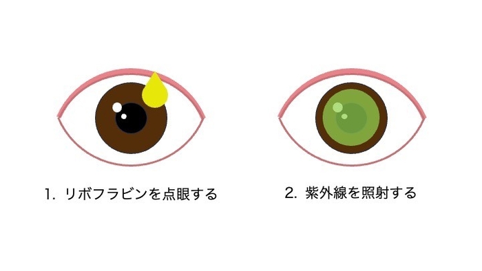 角膜クロスリンキングの手術方法