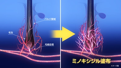 発毛成分「ミノキシジル」に新たな作用メカニズムを発見