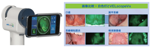 画像比較　白色灯とVELscope VX