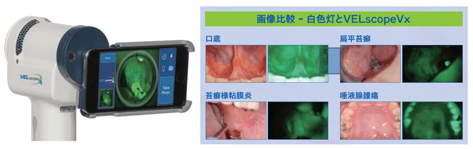 画像比較 白色灯とVELscope VX