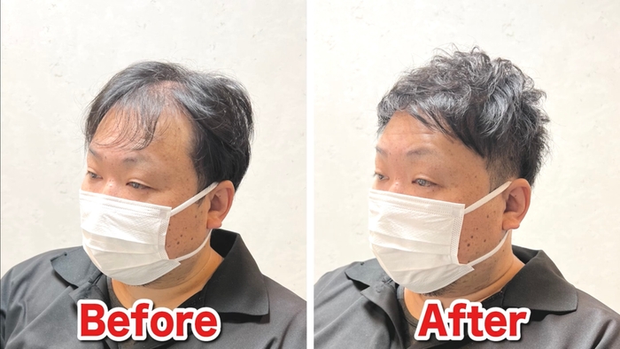 U字薄毛をカットで改善(4)
