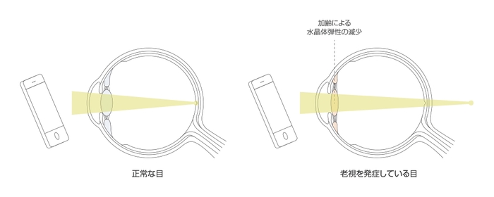 正常な目と老視を発症した目の比較