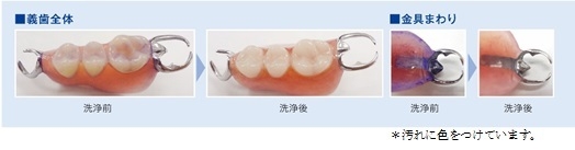 部分義歯の徹底洗浄