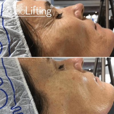 CooLifting 5