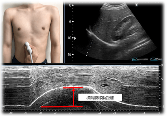 超音波画像診断装置を使用し、横隔膜移動距離を測定する様子