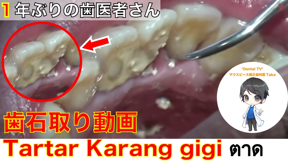1年でも歯石が溜まります。日々の歯磨き大切です！！
