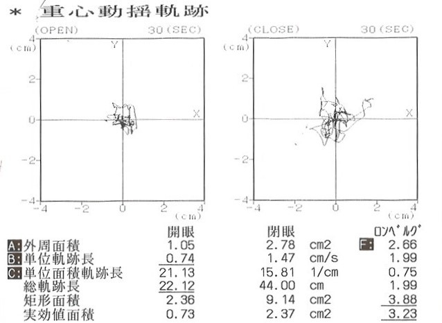 重心動揺平衡機能検査2