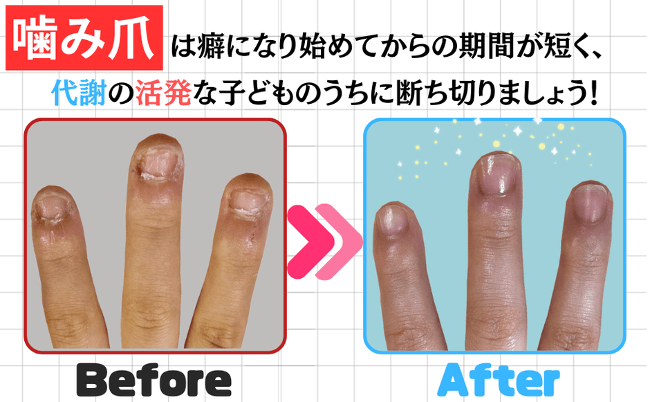 バイバイ！噛み爪_Before＆After