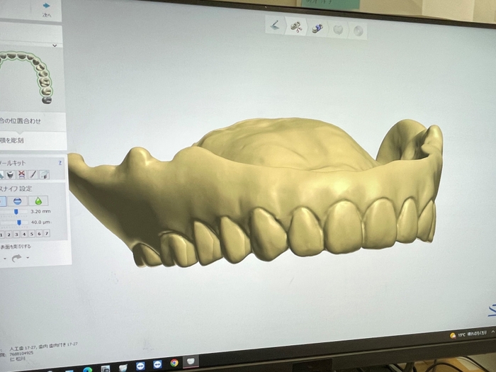 入れ歯の形状がデータに変換されてクラウド保管される