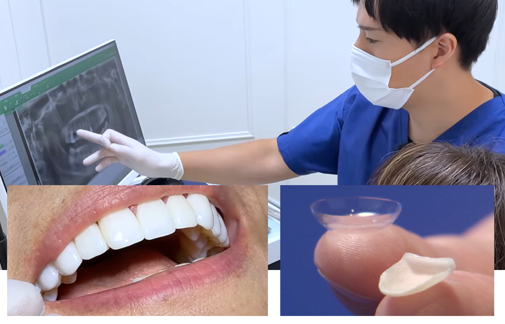 ラミネートベニア「ルミネアーズ治療」のモニターを9月より募集開始