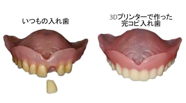 2. 歯が抜けている入れ歯を修復してコピー