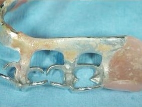 汚れが蓄積された部分入れ歯