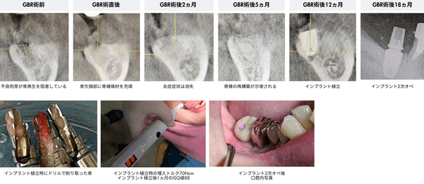 GBRからインプラント植立までの推移