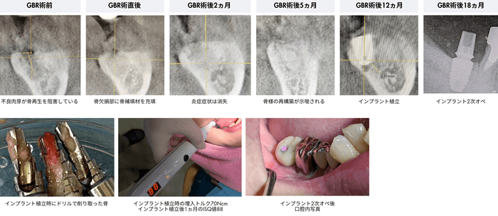 GBRからインプラント植立までの推移