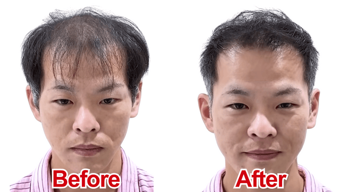U字薄毛をカットで改善(1)