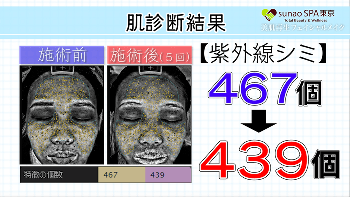 肌診断結果(シミ)