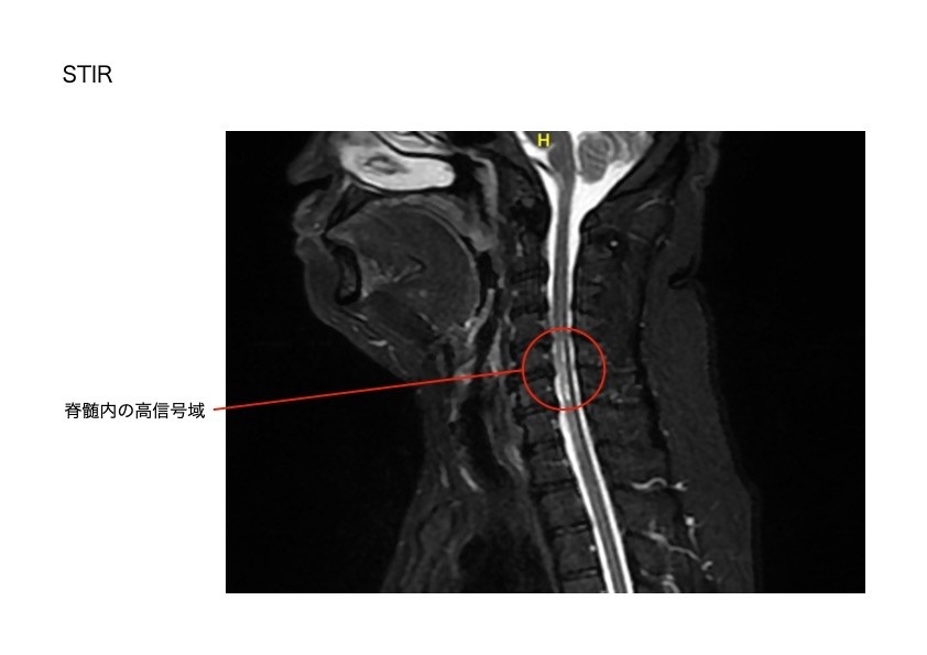STIR法によるMRI画像。脊髄内の病変部位を明瞭に示している