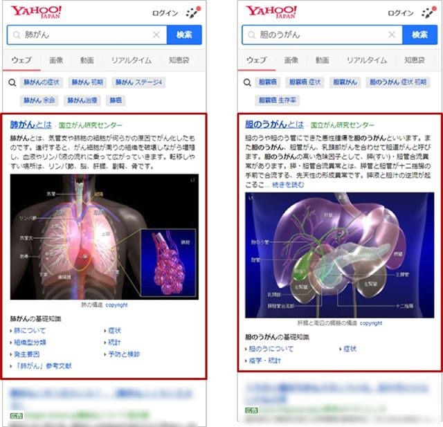 【アイレップ：画像1】Yahoo!検索（search.yahoo.co.jp）にて「肺がん」、「胆のうがん」の検索結果の表示例