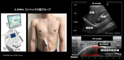 食道がん患者における術前吸気筋トレーニングの効果を検証　横隔膜機能を改善し、術後呼吸器合併症予防に寄与する可能性を示唆