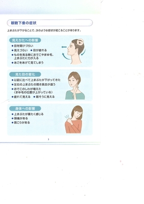 眼瞼下垂の症状