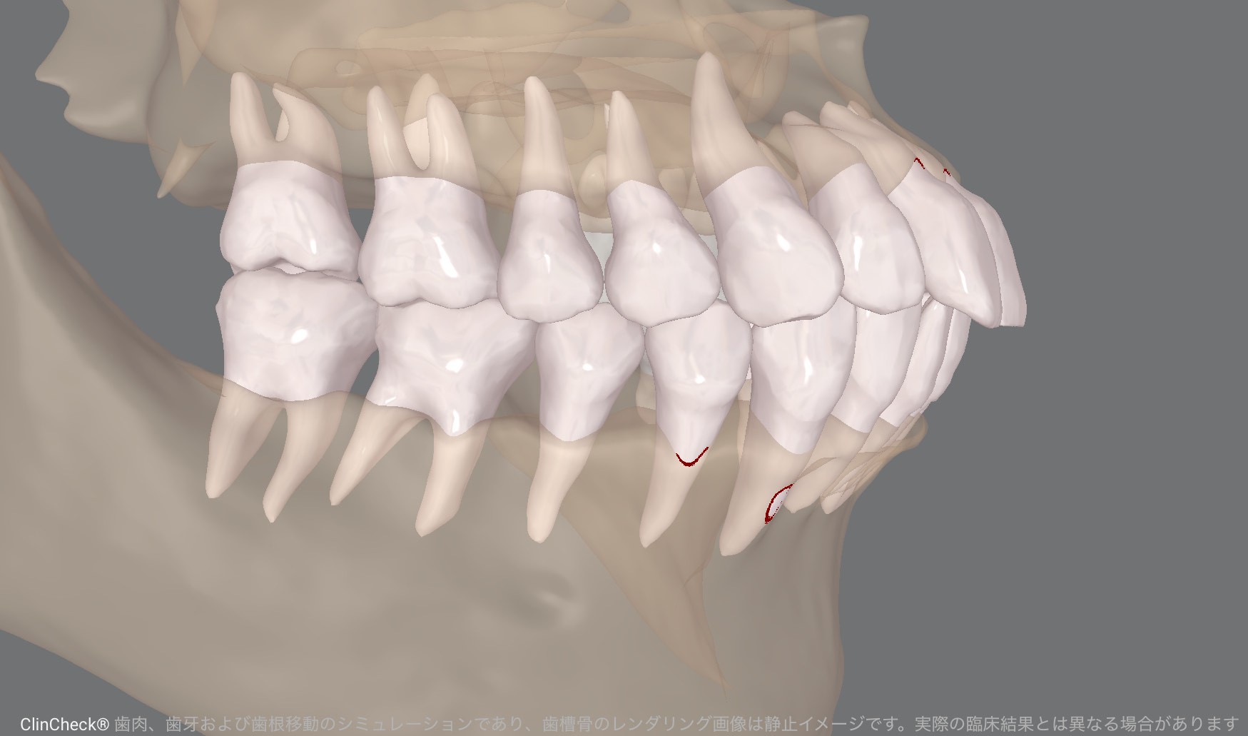 70歳で矯正治療を開始
AIとマウスピース矯正が後押しする「期限を決めた歯科治療」という選択